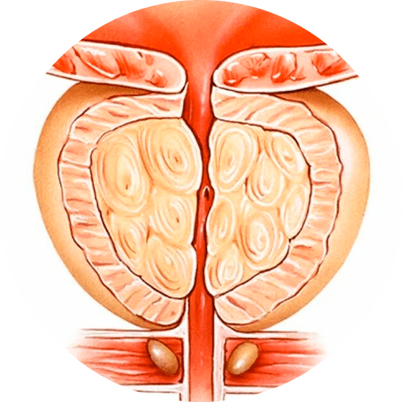 Conséquences d'une prostatite non traitée