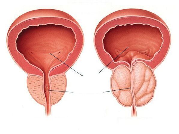 prostate saine et malade